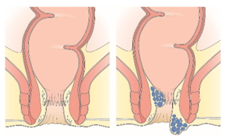 Cara menghilangkan benjolan wasir alami, jual obat untuk mengobati wasir di sidenreng, obat penyakit wasir di solok, jual obat buat penyakit ambeien di sorong selatan, jual obat untuk penyakit ambeien di sarila, obat untuk mengobati wasir di slawi, obat buat penyakit wasir di sidikalang, jual obat penyakit wasir di sekayu, jual obat untuk penyakit ambeien di salak, obat buat penyakit wasir dalam alami, obat alami wasir atau ambeien atau ambeyen